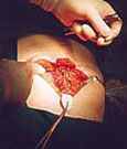 Abdominal Surgery