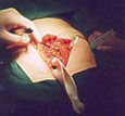 Abdominal Surgery